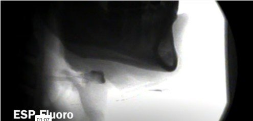 ESP fluoroskopi görüntüleme videosu